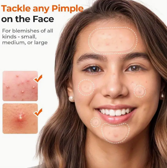 Hydrocolloid Acne Pimple Patches